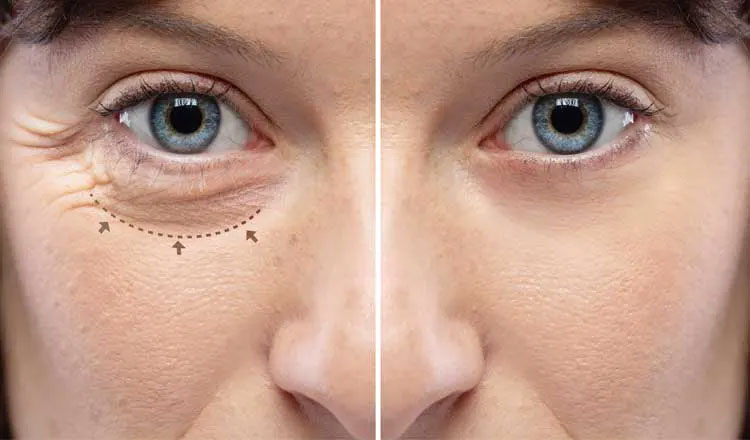 antes e depois blefaroplastia antes e depois blefaroplastia