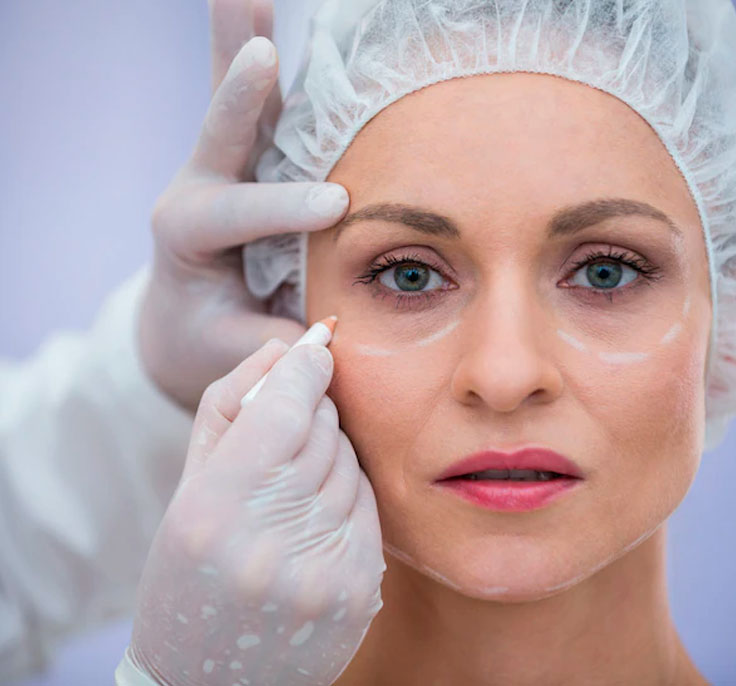 Blefaroplastia
